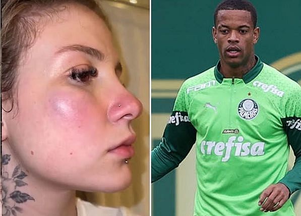 Ana Clara mostra hematomas e denuncia o jogador Caio Paulista