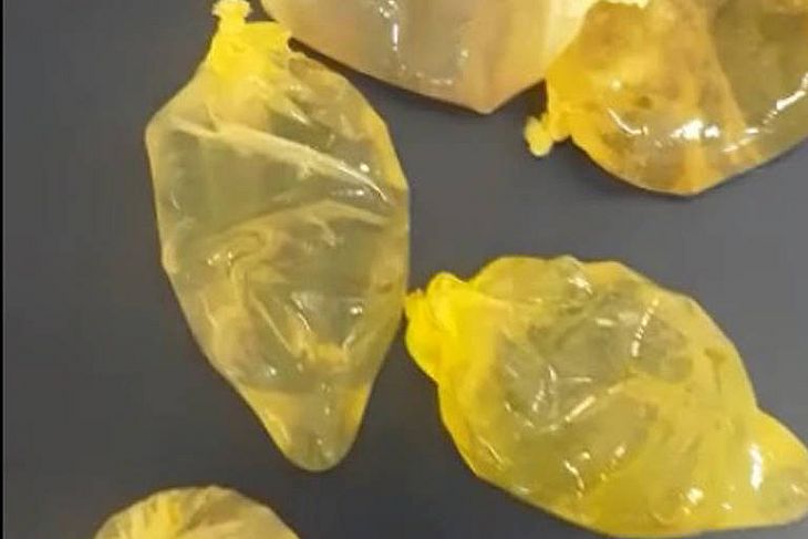 Cinco preservativos, dentro dos quais havia cocaína liquida, foram expelidos por uma mulher de 35 anos, em um hospital da zona leste da capital paulista, nessa segunda-feira (28)