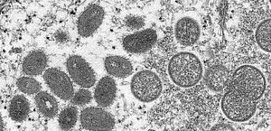 Distrito Federal tem primeiro caso de varíola dos macacos