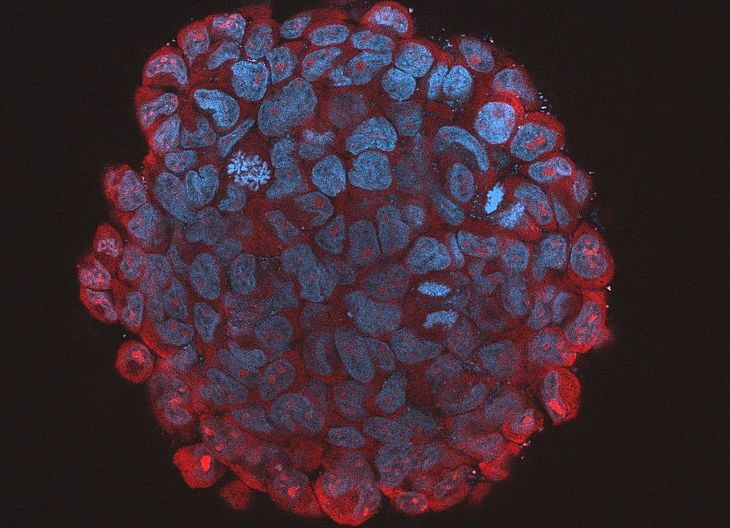 Inibidor de microRNA identificado por pesquisadores reduziu o tamanho de tumores agressivos e aumentou a sobrevida em testes com camundongos