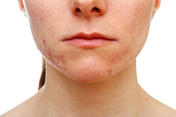 A acne, vulgarmente conhecida como espinhas e cravos, aparece em decorrência de processos inflamatórios das glândulas sebáceas e folículos pilossebáceos