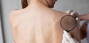Brasil deve registrar 704 mil novos casos de câncer de pele em 3 anos
