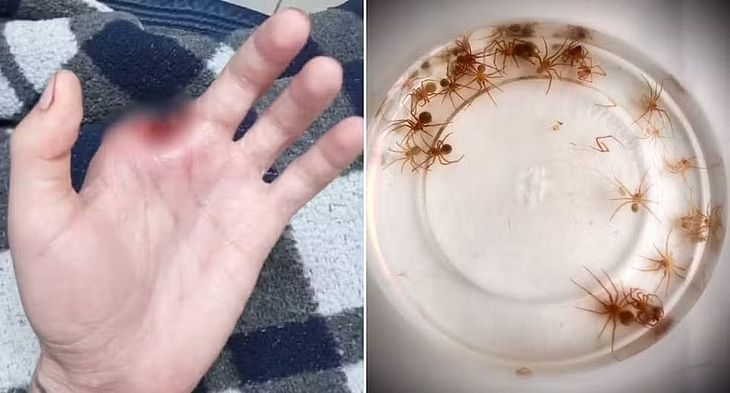 Homem teve o dedo amputado após ser picado por uma aranha-marrom 