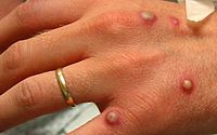 Monkeypox: após 1ª confirmação, número de casos em investigação sobe para 35 em AL 